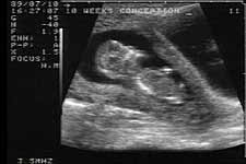 unbornbaby10weeksultrasound