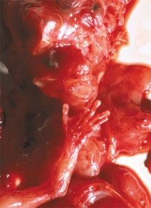 aborted at 10 weeks