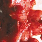 Aborted baby at 10 weeks – 40% of abortions are done at this time or later