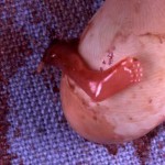 Foot of an aborted baby at 9 weeks. 