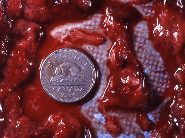 Remains of the baby aborted at nine weeks by suction