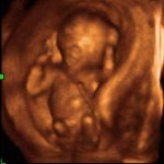 1st trimester 3d ultrasound
