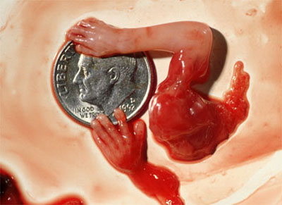 Left over from an abortion at 10 weeks