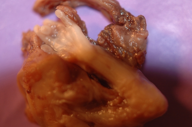 Remains of baby aborted at 18 weeks