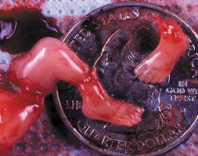 From an abortion at 10 weeks
